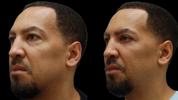 Lower Eyelid Surgery Before & After Gallery - Patient 399063 - Image 1