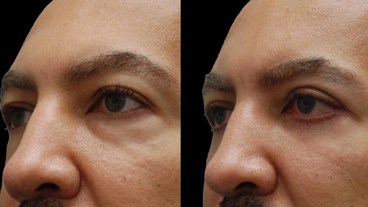 Lower Eyelid Surgery Before & After Gallery - Patient 399063 - Image 5
