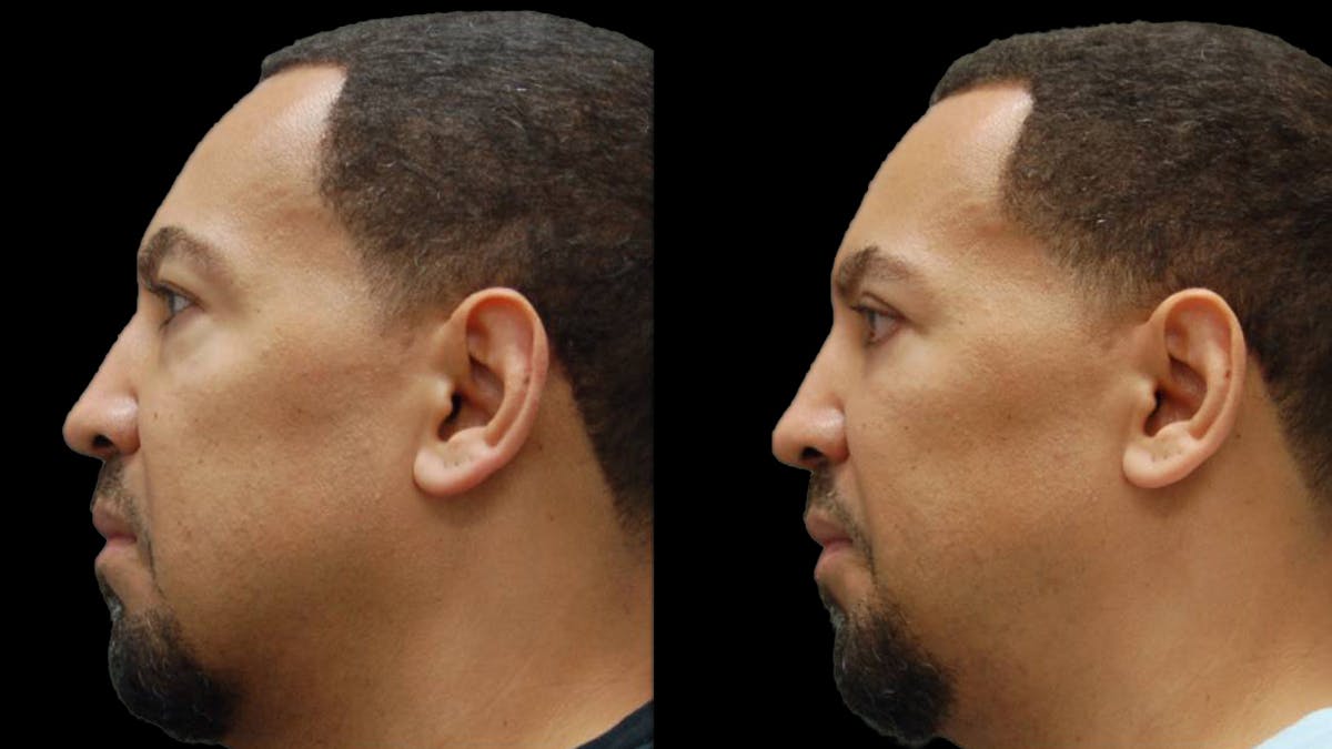 Lower Eyelid Surgery Before & After Gallery - Patient 399063 - Image 3