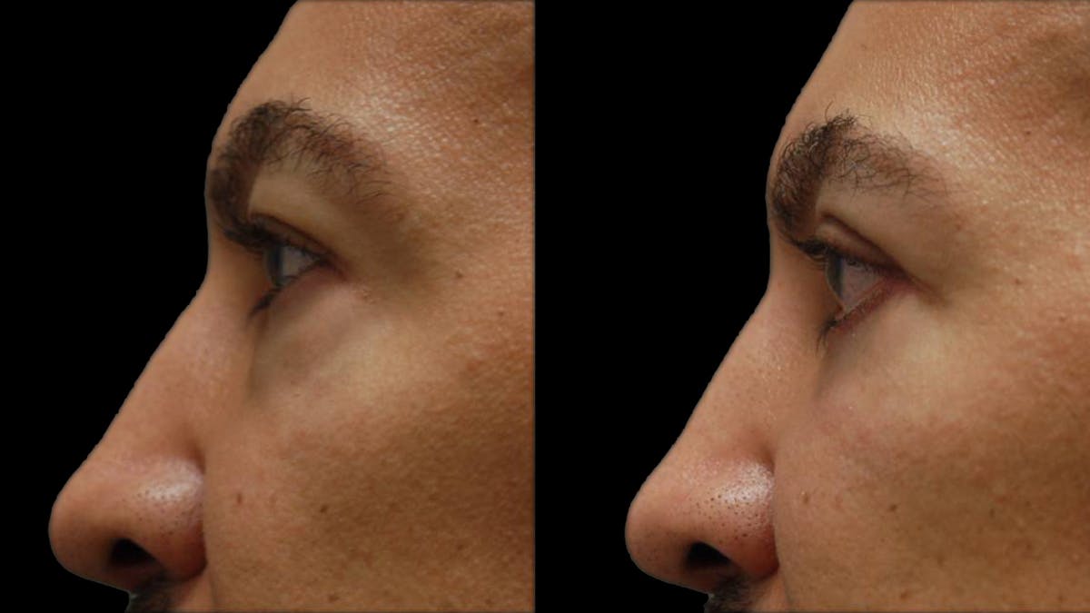 Lower Eyelid Surgery Before & After Gallery - Patient 399063 - Image 6