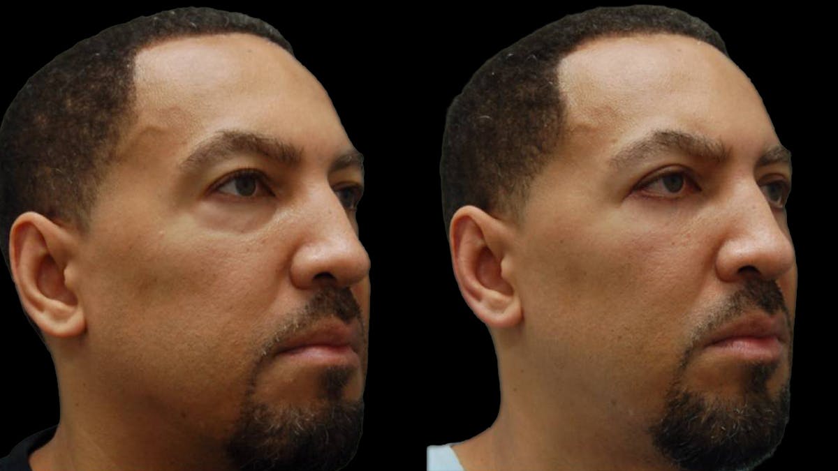 Lower Eyelid Surgery Before & After Gallery - Patient 399063 - Image 4