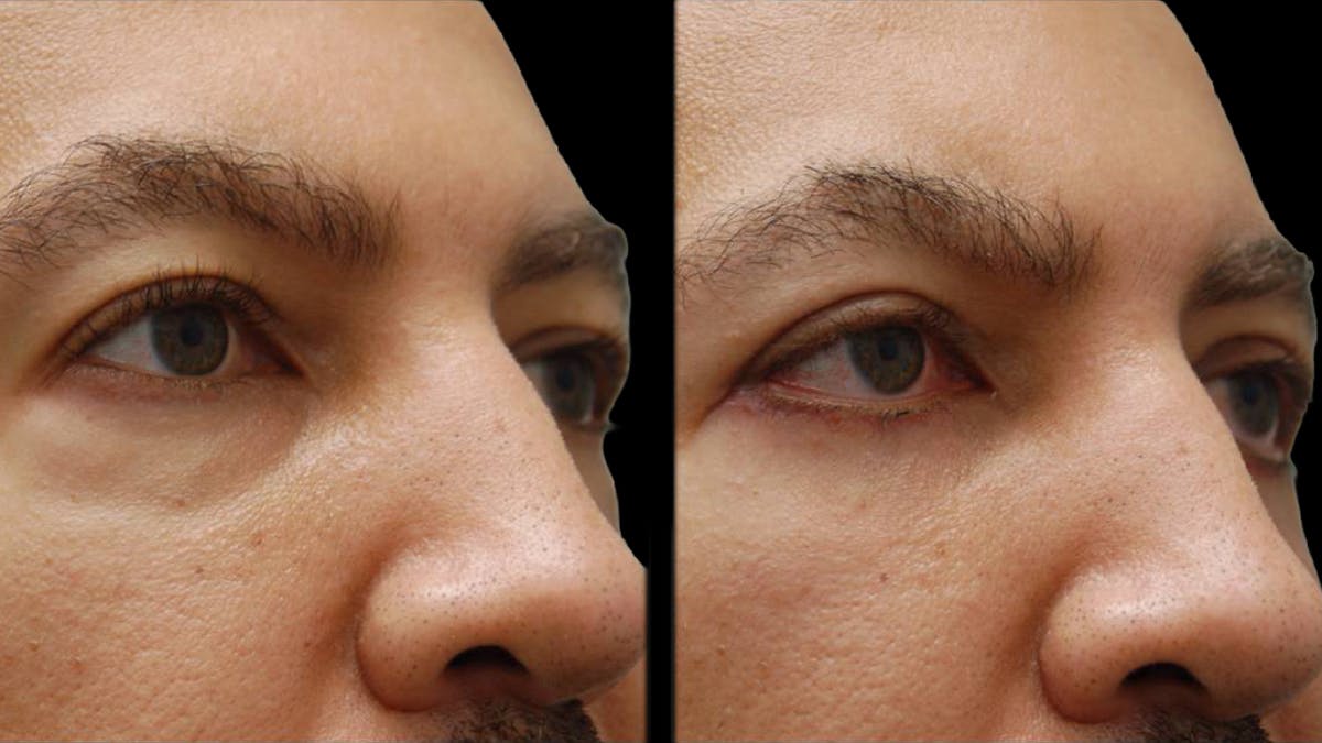 Lower Eyelid Surgery Before & After Gallery - Patient 399063 - Image 7