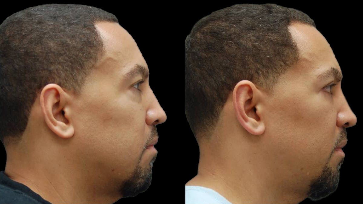 Lower Eyelid Surgery Before & After Gallery - Patient 399063 - Image 8