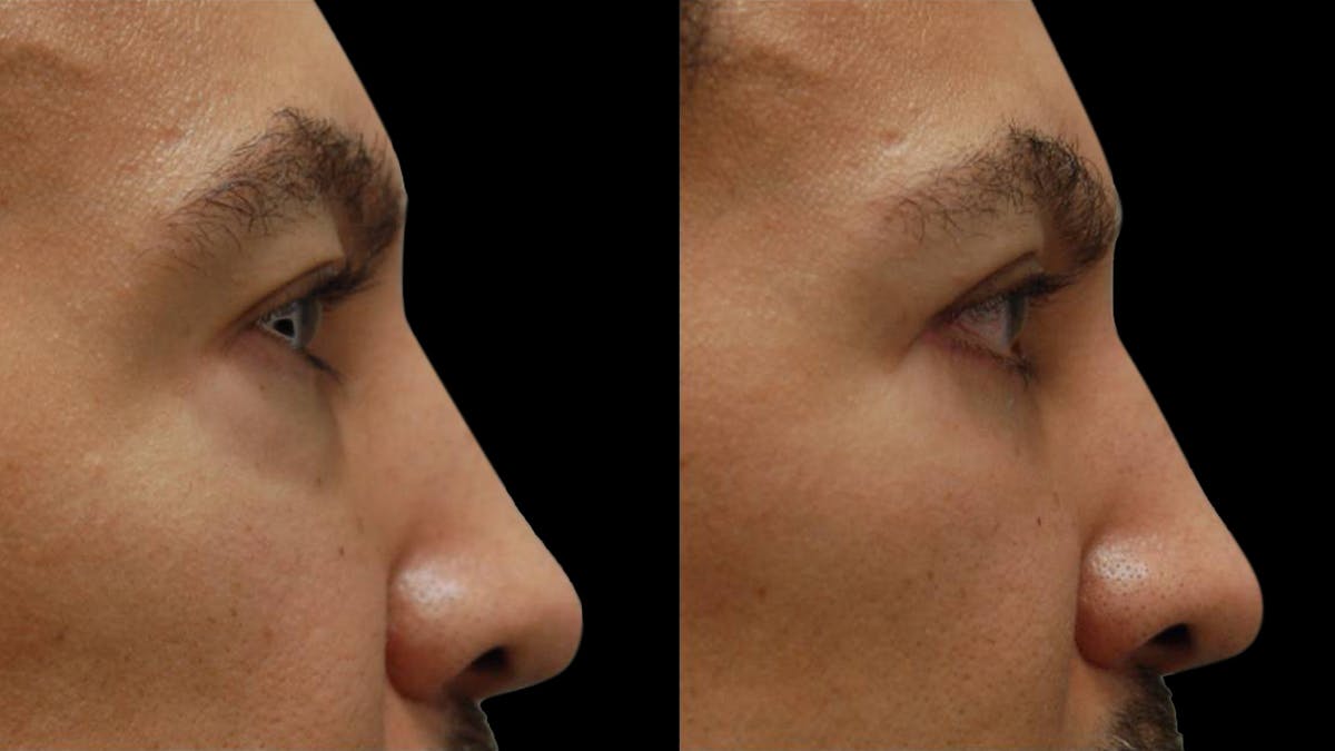 Lower Eyelid Surgery Before & After Gallery - Patient 399063 - Image 9