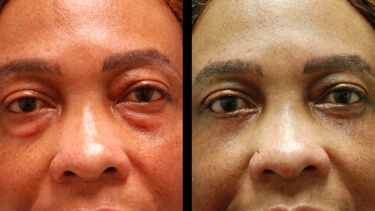 Lower Eyelid Surgery Before & After Gallery - Patient 282674 - Image 6