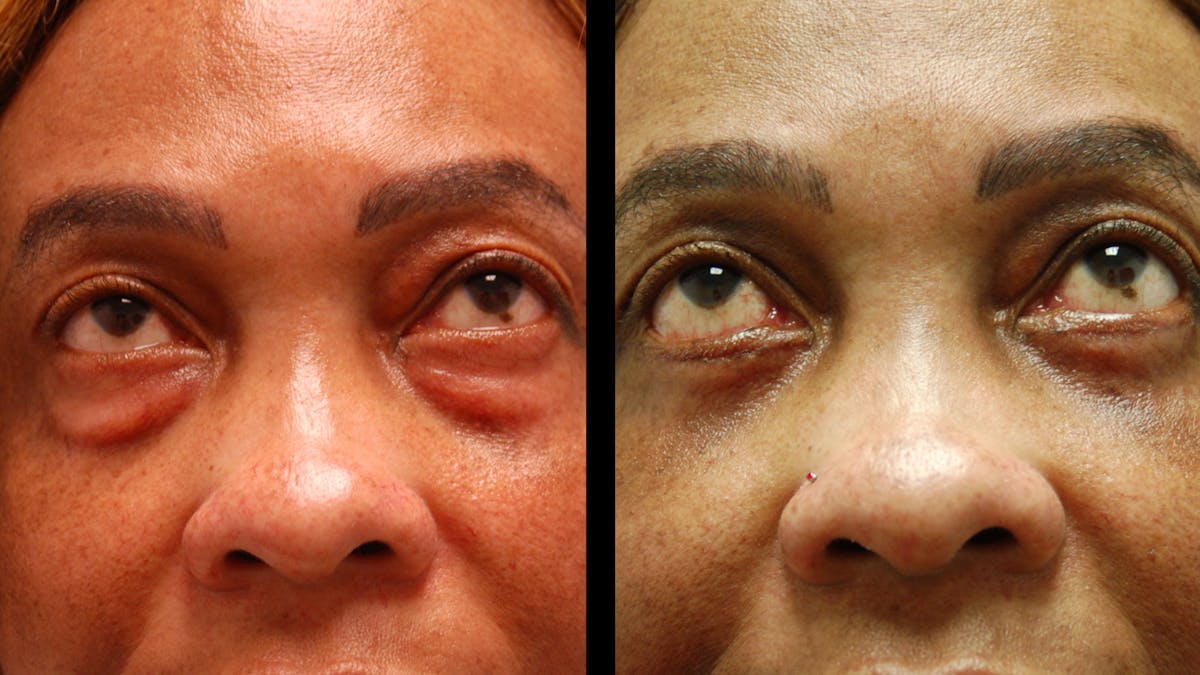 Lower Eyelid Surgery Before & After Gallery - Patient 282674 - Image 7