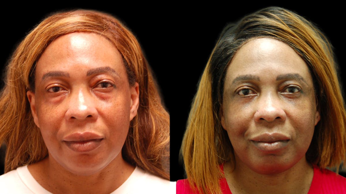 Lower Eyelid Surgery Before & After Gallery - Patient 282674 - Image 2