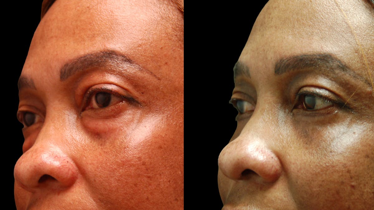 Lower Eyelid Surgery Before & After Gallery - Patient 282674 - Image 8