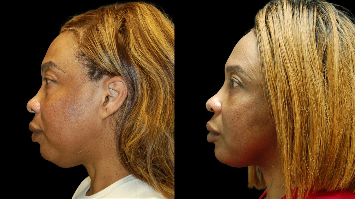 Lower Eyelid Surgery Before & After Gallery - Patient 282674 - Image 4