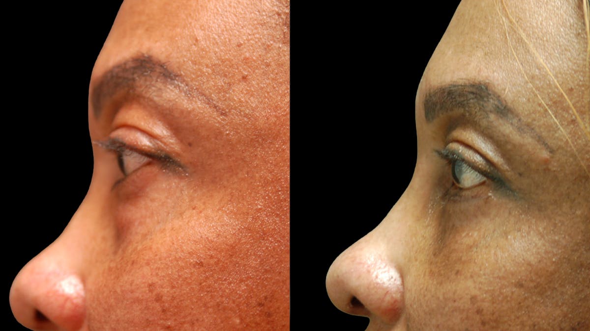 Lower Eyelid Surgery Before & After Gallery - Patient 282674 - Image 9