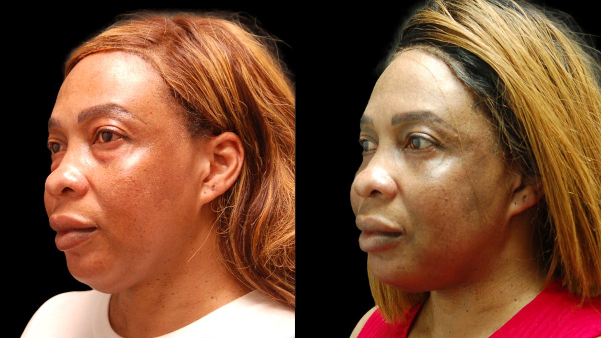 Lower Eyelid Surgery Before & After Gallery - Patient 282674 - Image 1