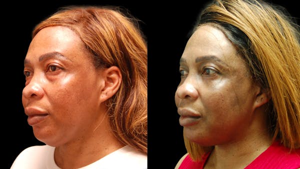 Lower Eyelid Surgery Before & After Gallery - Patient 282674 - Image 1