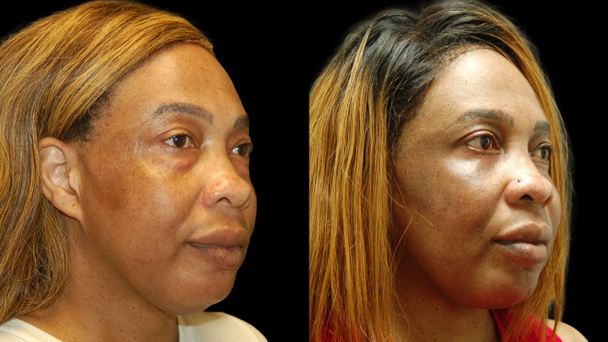 Lower Eyelid Surgery Before & After Gallery - Patient 282674 - Image 3