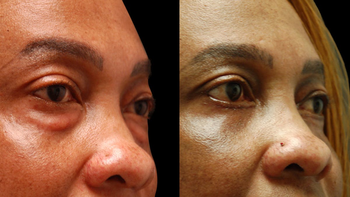 Lower Eyelid Surgery Before & After Gallery - Patient 282674 - Image 10