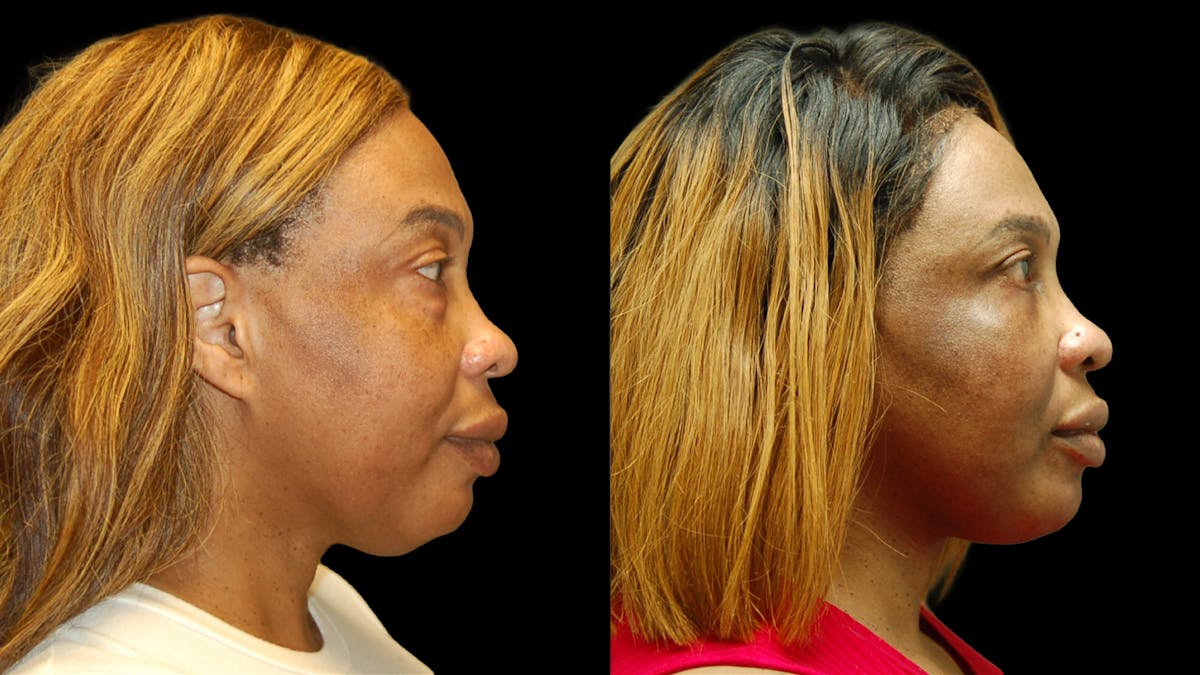 Lower Eyelid Surgery Before & After Gallery - Patient 282674 - Image 5