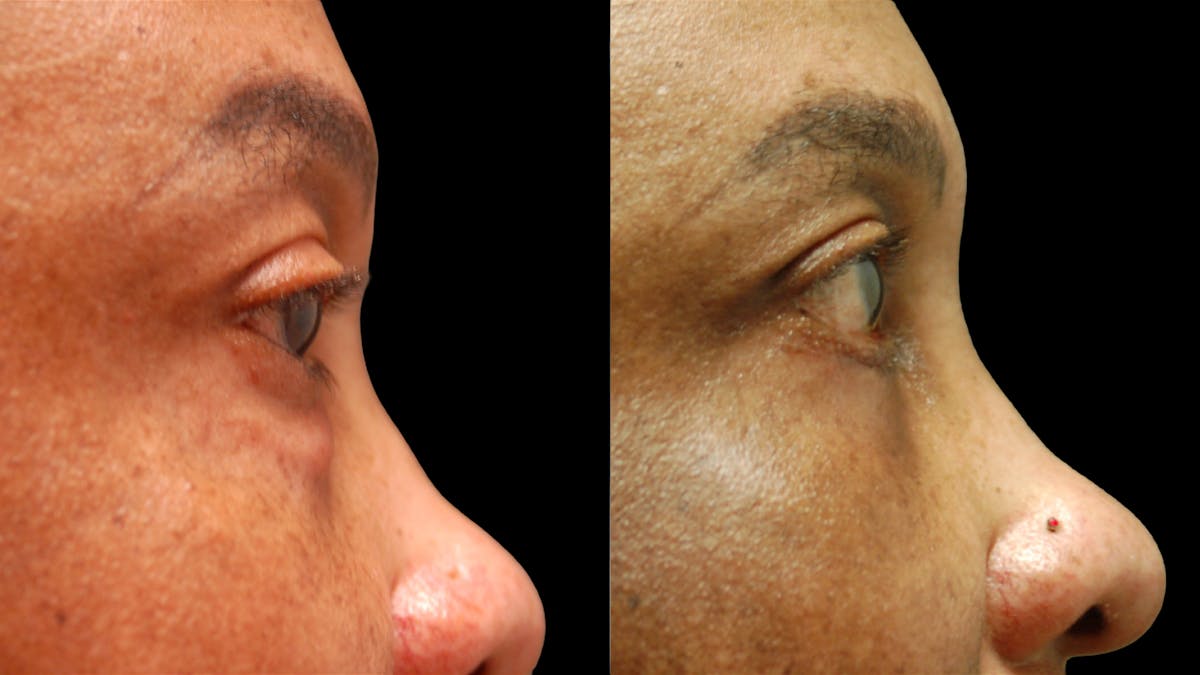 Lower Eyelid Surgery Before & After Gallery - Patient 282674 - Image 11