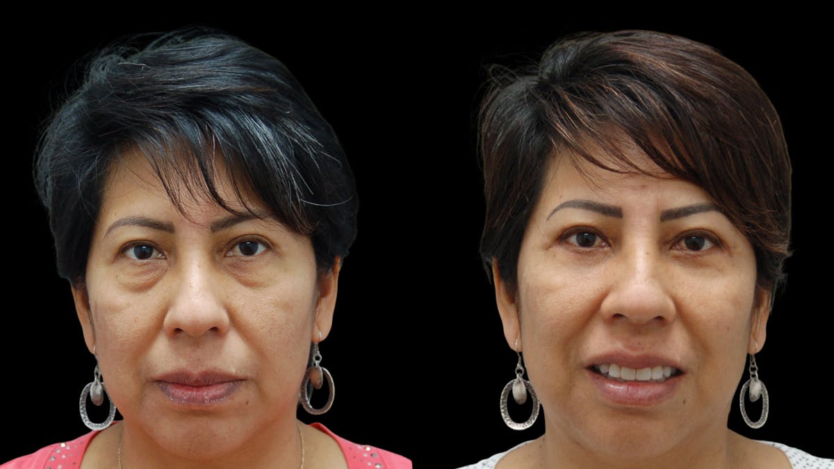 Lower Eyelid Surgery Before & After Gallery - Patient 125550 - Image 3