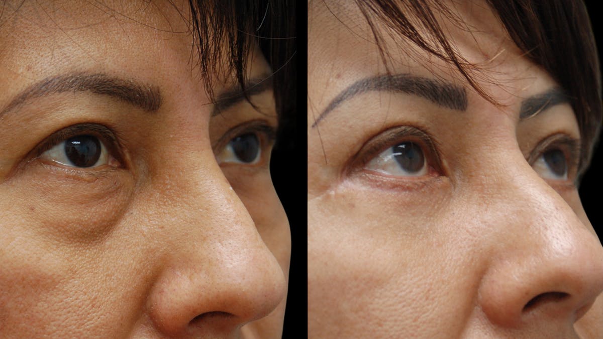 Lower Eyelid Surgery Before & After Gallery - Patient 125550 - Image 6