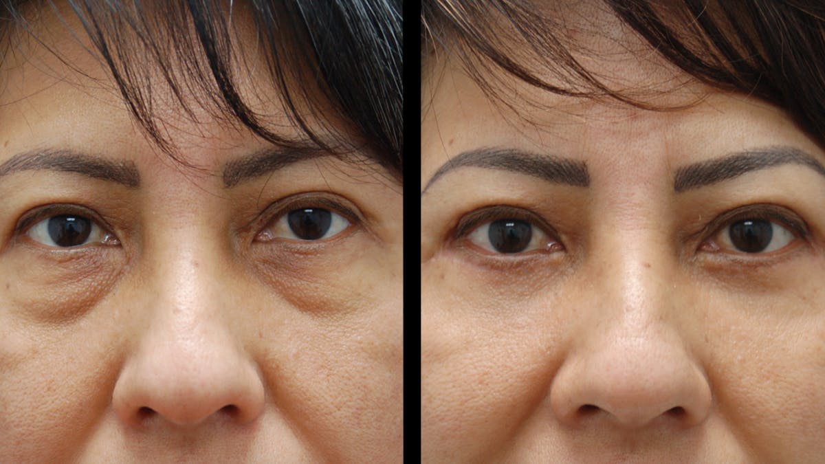 Lower Eyelid Surgery Before & After Gallery - Patient 125550 - Image 7
