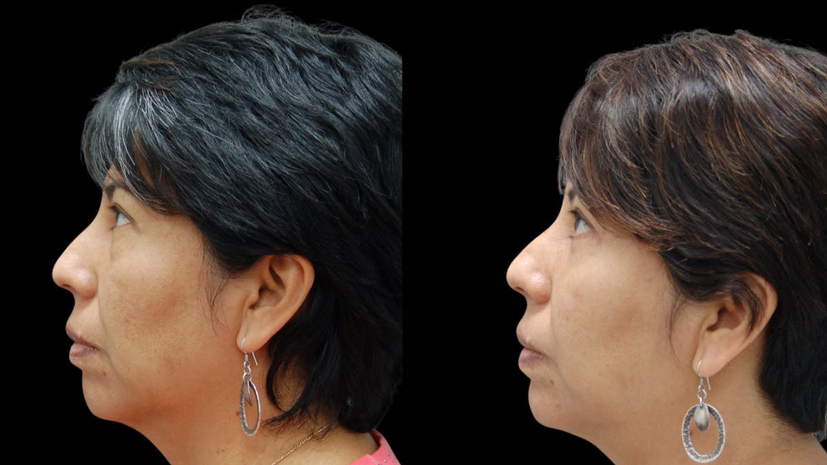 Lower Eyelid Surgery Before & After Gallery - Patient 125550 - Image 4