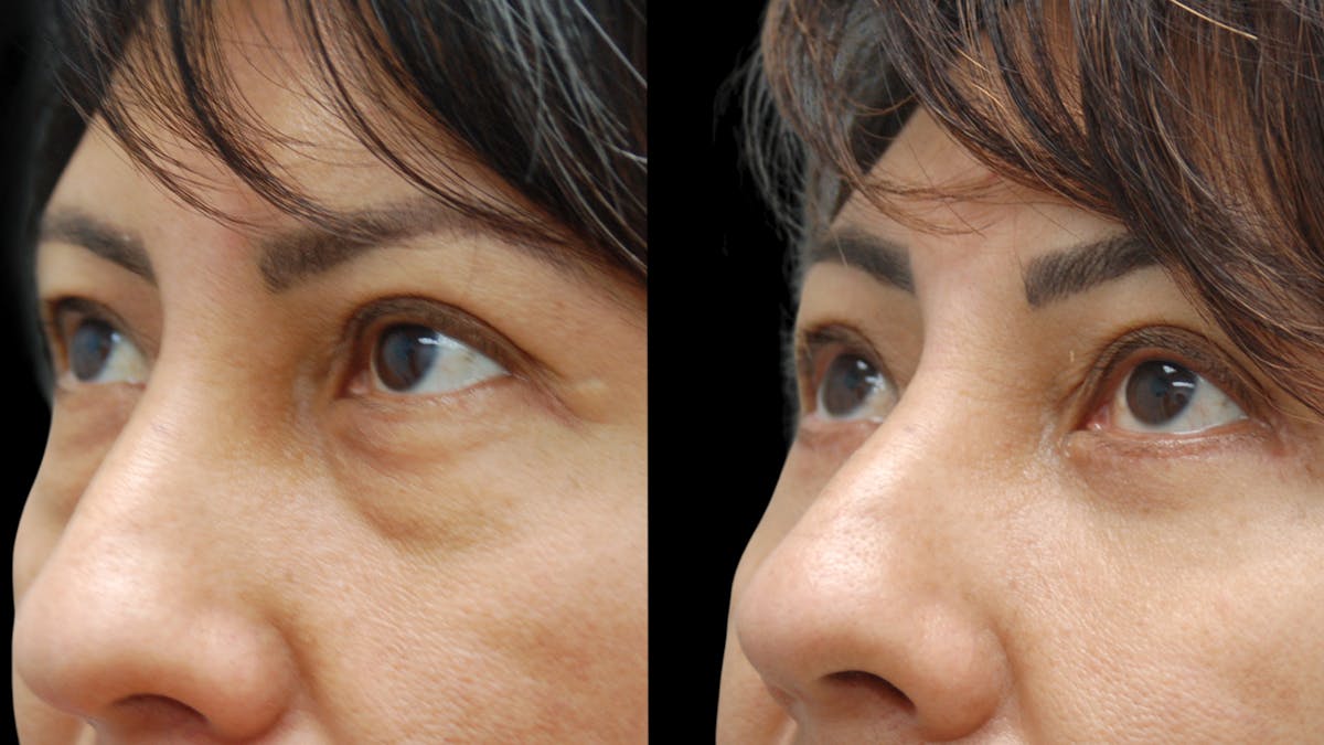 Lower Eyelid Surgery Before & After Gallery - Patient 125550 - Image 8