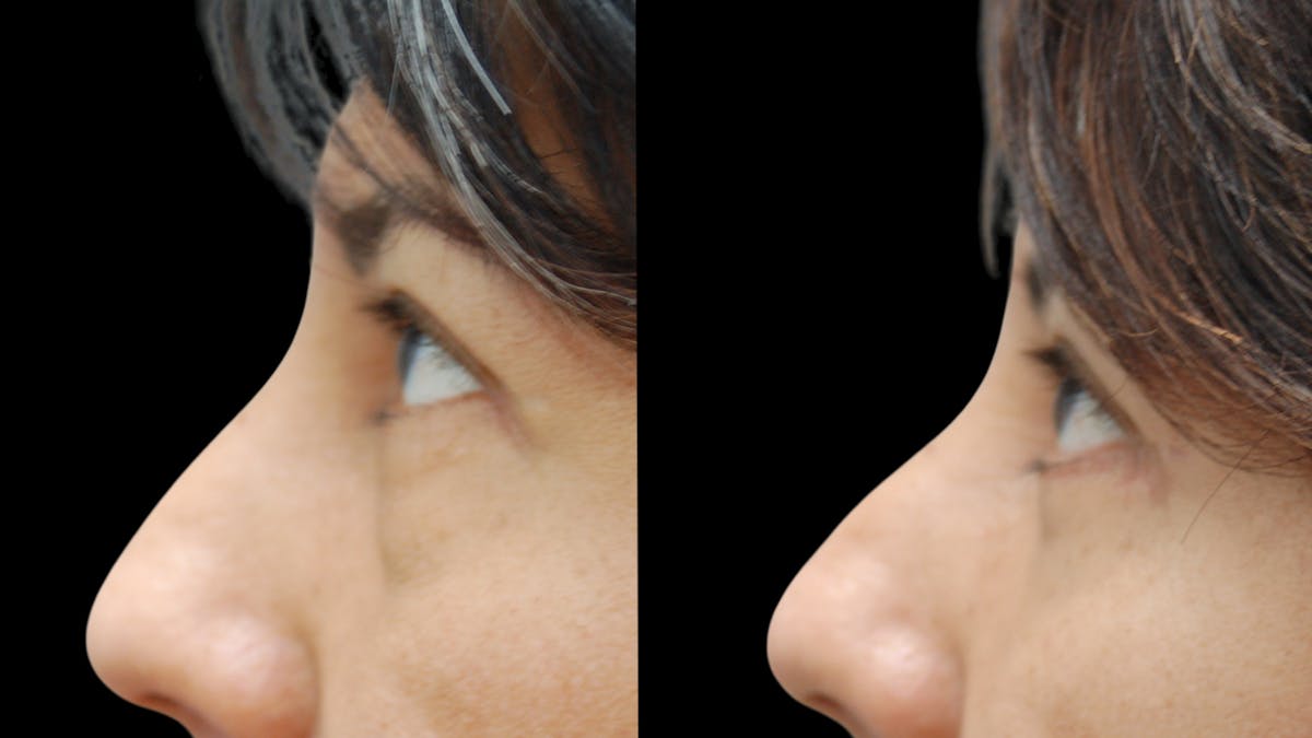 Lower Eyelid Surgery Before & After Gallery - Patient 125550 - Image 9