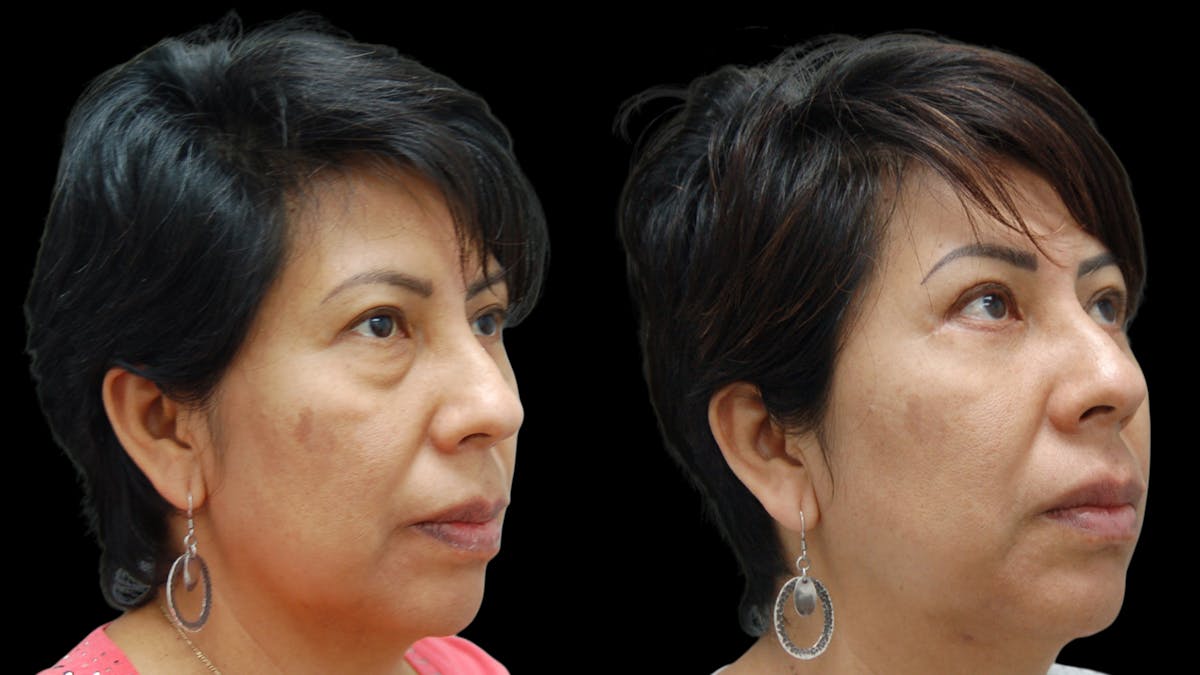Lower Eyelid Surgery Before & After Gallery - Patient 125550 - Image 2