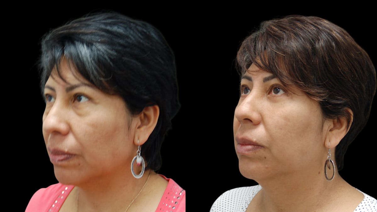 Lower Eyelid Surgery Before & After Gallery - Patient 125550 - Image 1