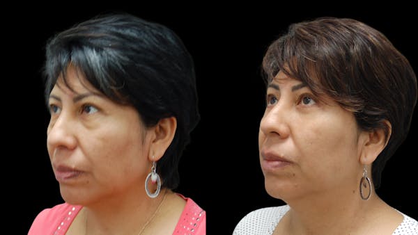 Lower Eyelid Surgery Before & After Gallery - Patient 125550 - Image 1