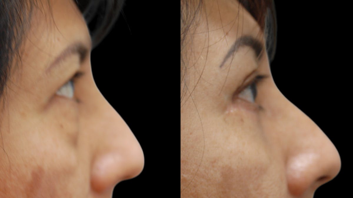 Lower Eyelid Surgery Before & After Gallery - Patient 125550 - Image 10