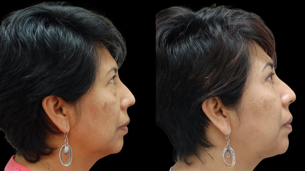 Lower Eyelid Surgery Before & After Gallery - Patient 125550 - Image 5
