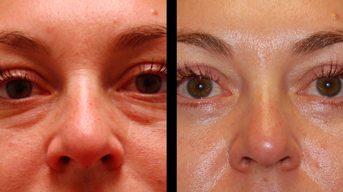 Lower Eyelid Surgery Before & After Gallery - Patient 100316 - Image 7