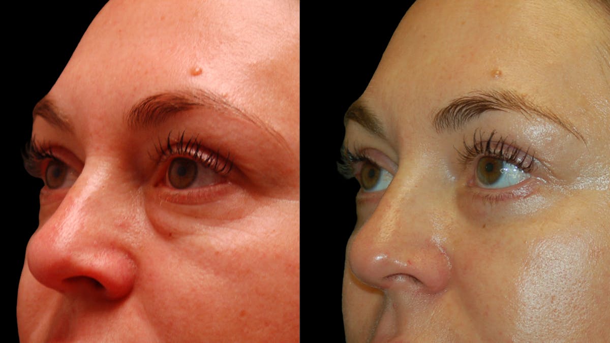 Lower Eyelid Surgery Before & After Gallery - Patient 100316 - Image 8
