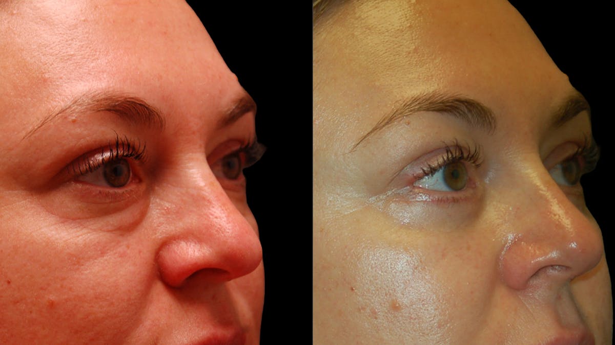 Lower Eyelid Surgery Before & After Gallery - Patient 100316 - Image 9