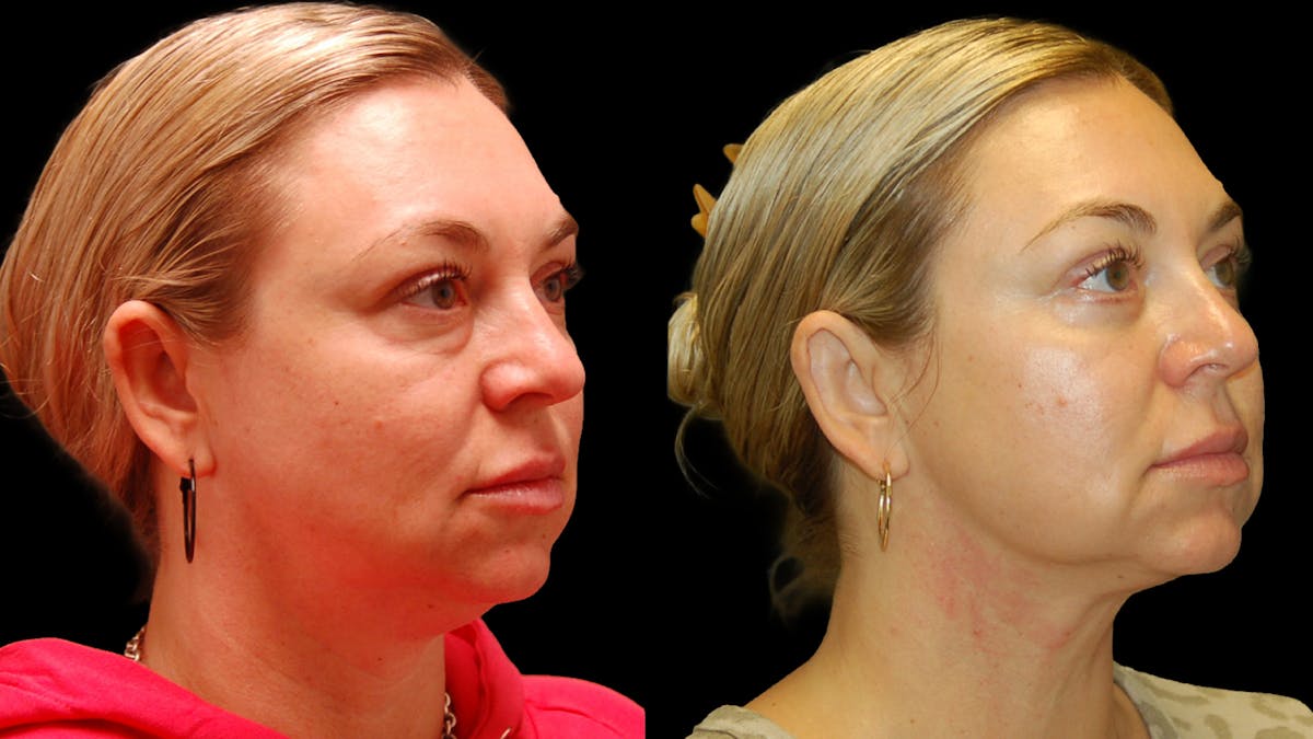 Lower Eyelid Surgery Before & After Gallery - Patient 100316 - Image 3