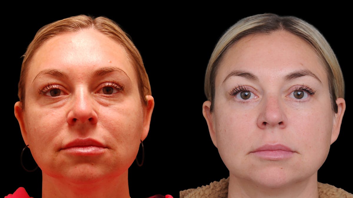 Lower Eyelid Surgery Before & After Gallery - Patient 100316 - Image 2