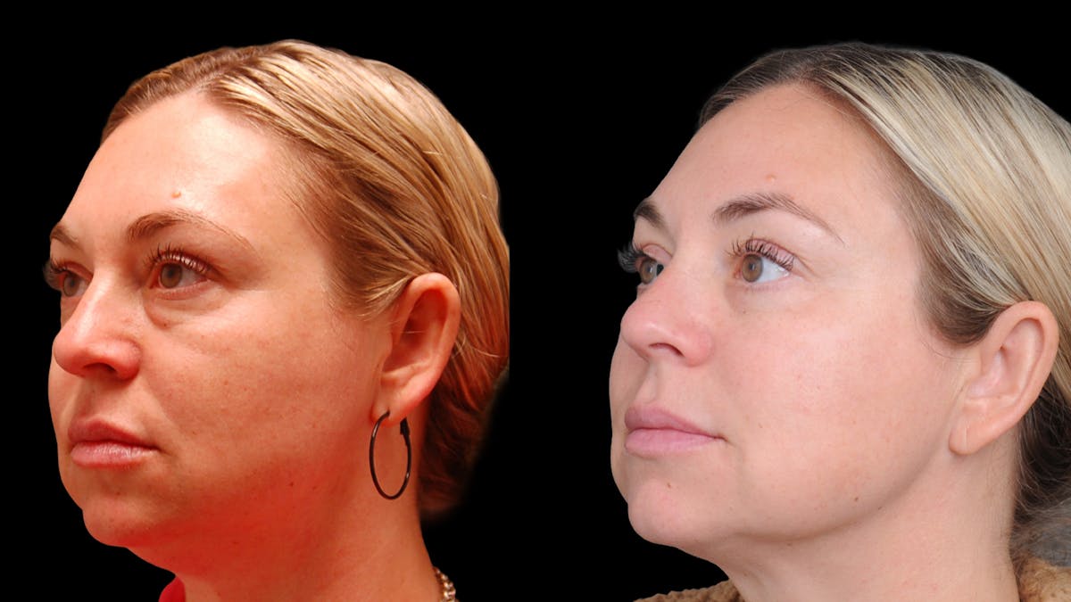 Lower Eyelid Surgery Before & After Gallery - Patient 100316 - Image 1