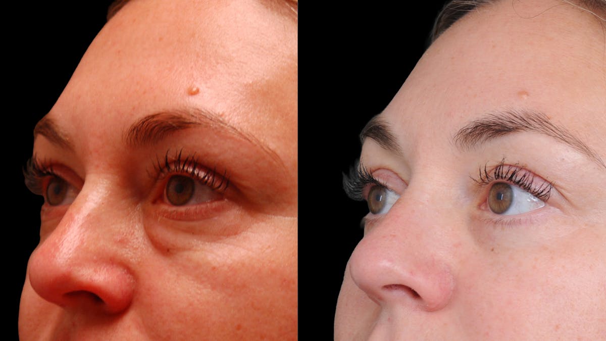 Lower Eyelid Surgery Before & After Gallery - Patient 100316 - Image 10