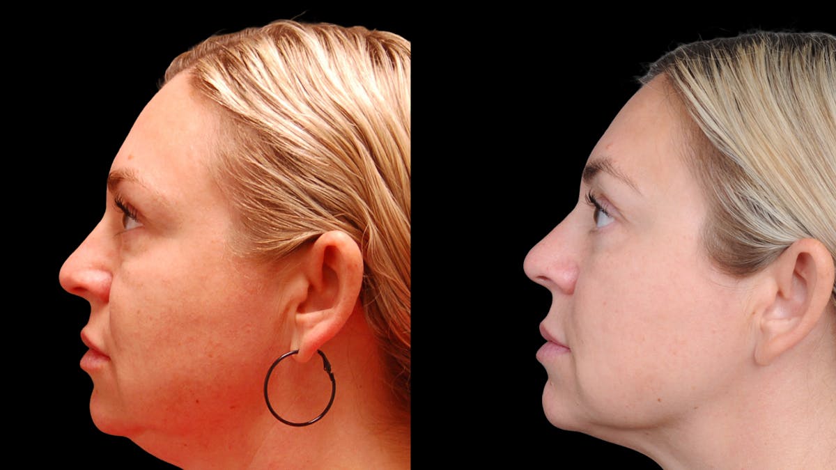 Lower Eyelid Surgery Before & After Gallery - Patient 100316 - Image 6