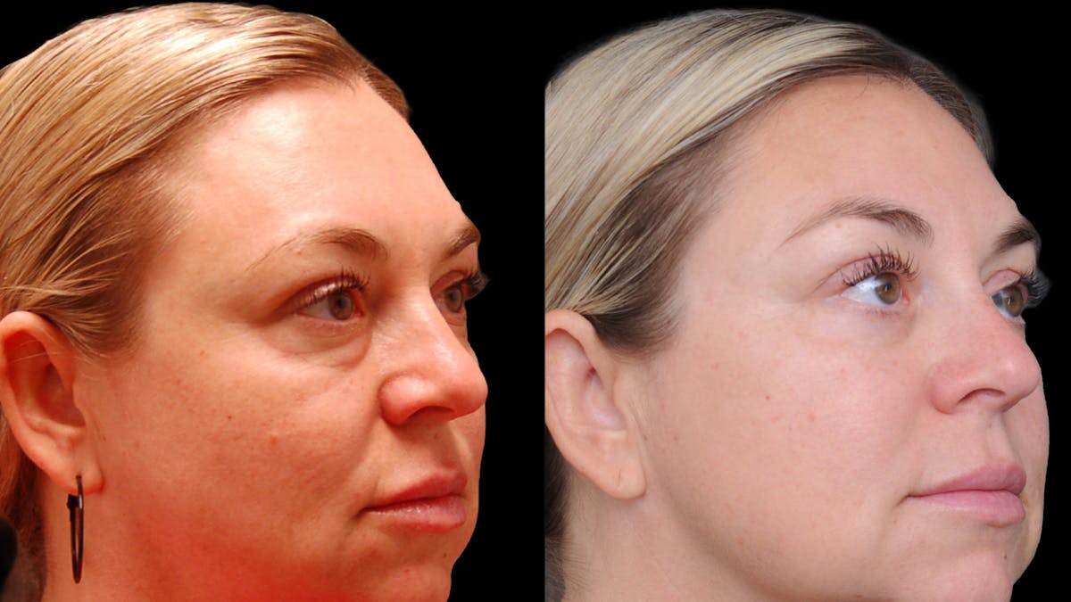 Lower Eyelid Surgery Before & After Gallery - Patient 100316 - Image 4