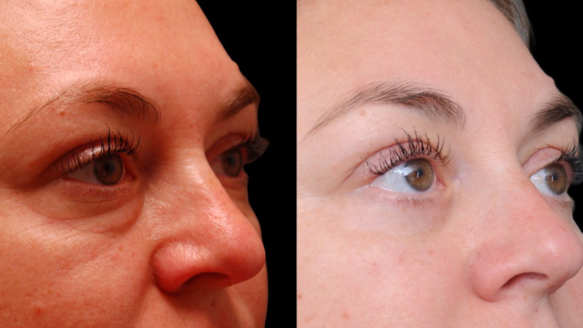Lower Eyelid Surgery Before & After Gallery - Patient 100316 - Image 11