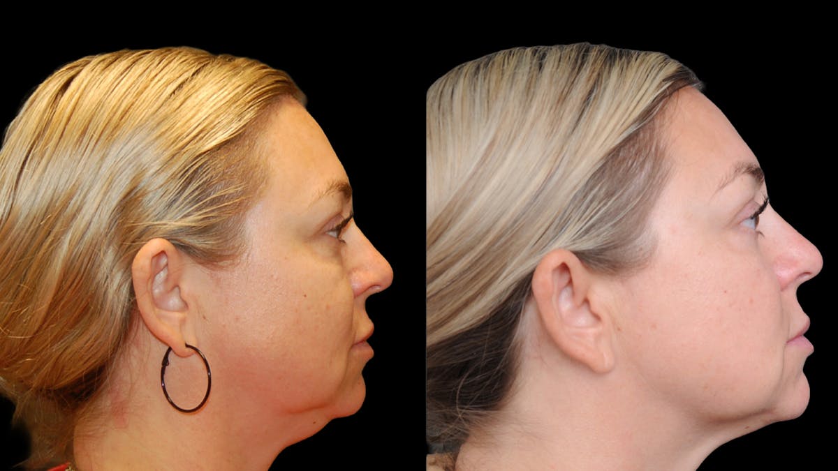 Lower Eyelid Surgery Before & After Gallery - Patient 100316 - Image 5