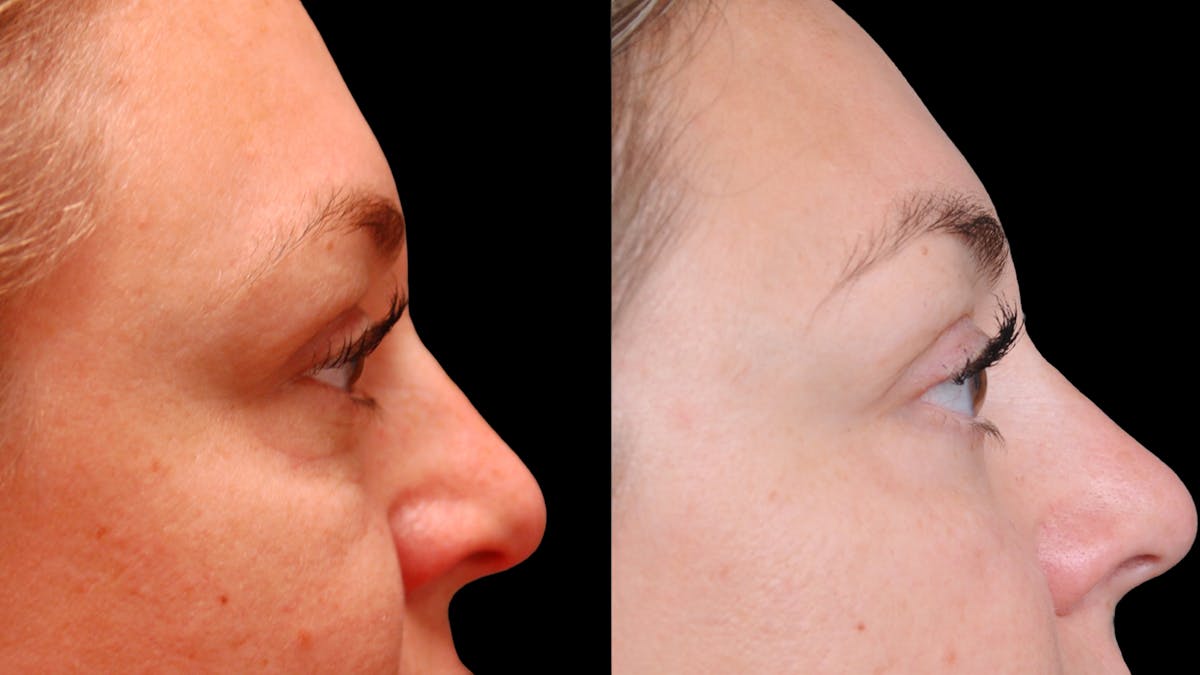 Lower Eyelid Surgery Before & After Gallery - Patient 100316 - Image 12