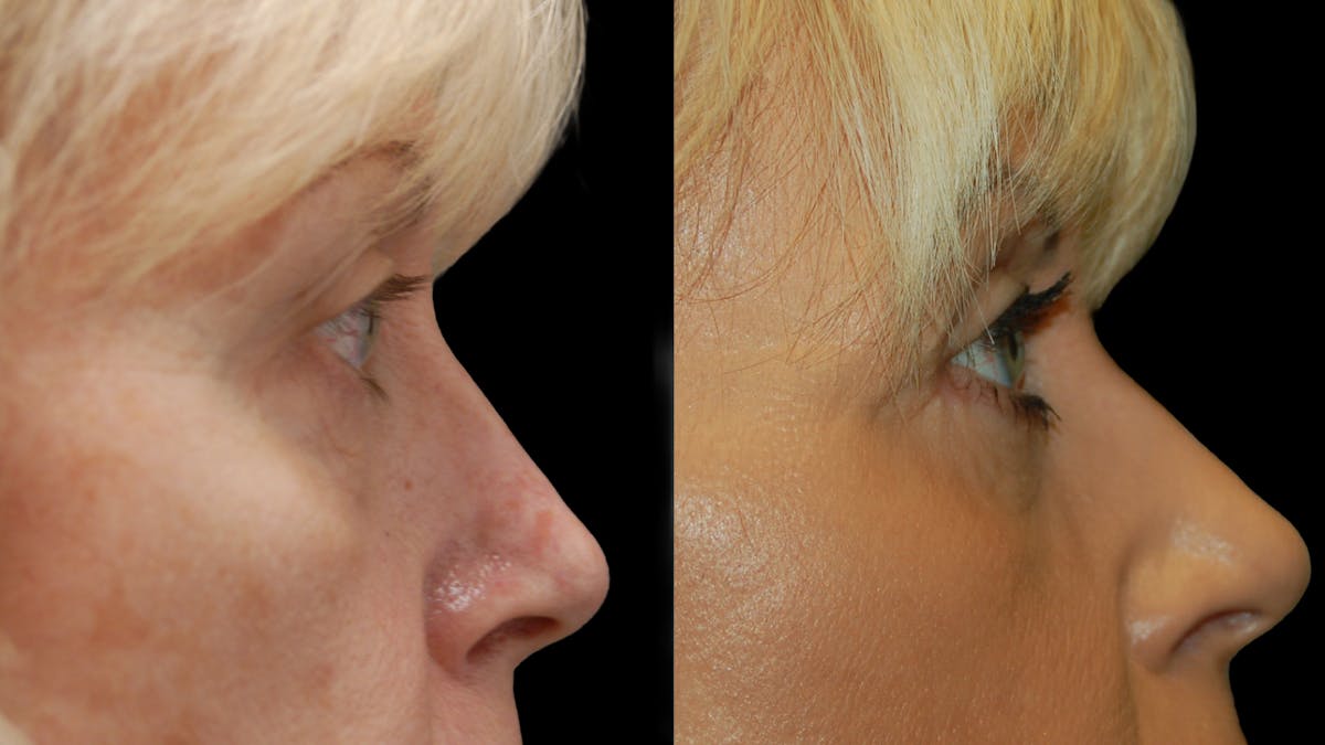 Lower Eyelid Surgery Before & After Gallery - Patient 358996 - Image 6