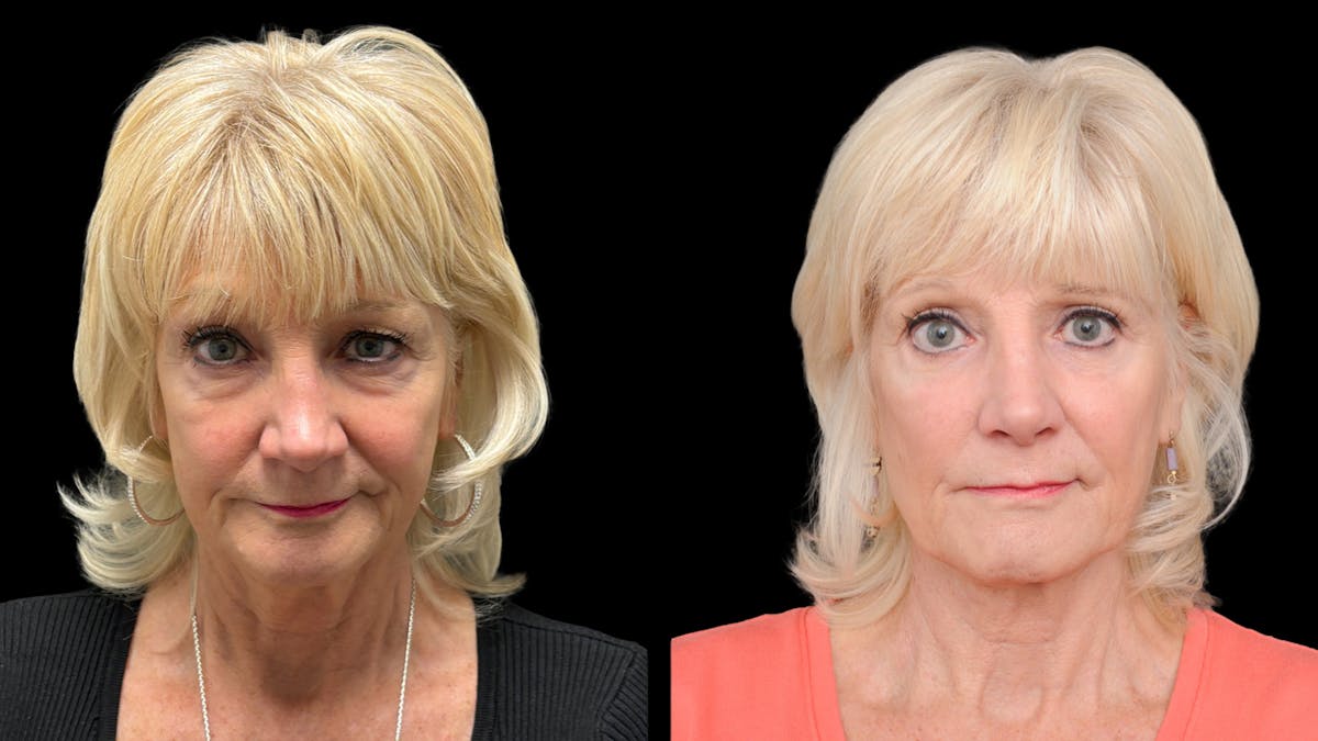 Lower Eyelid Surgery Before & After Gallery - Patient 358996 - Image 2
