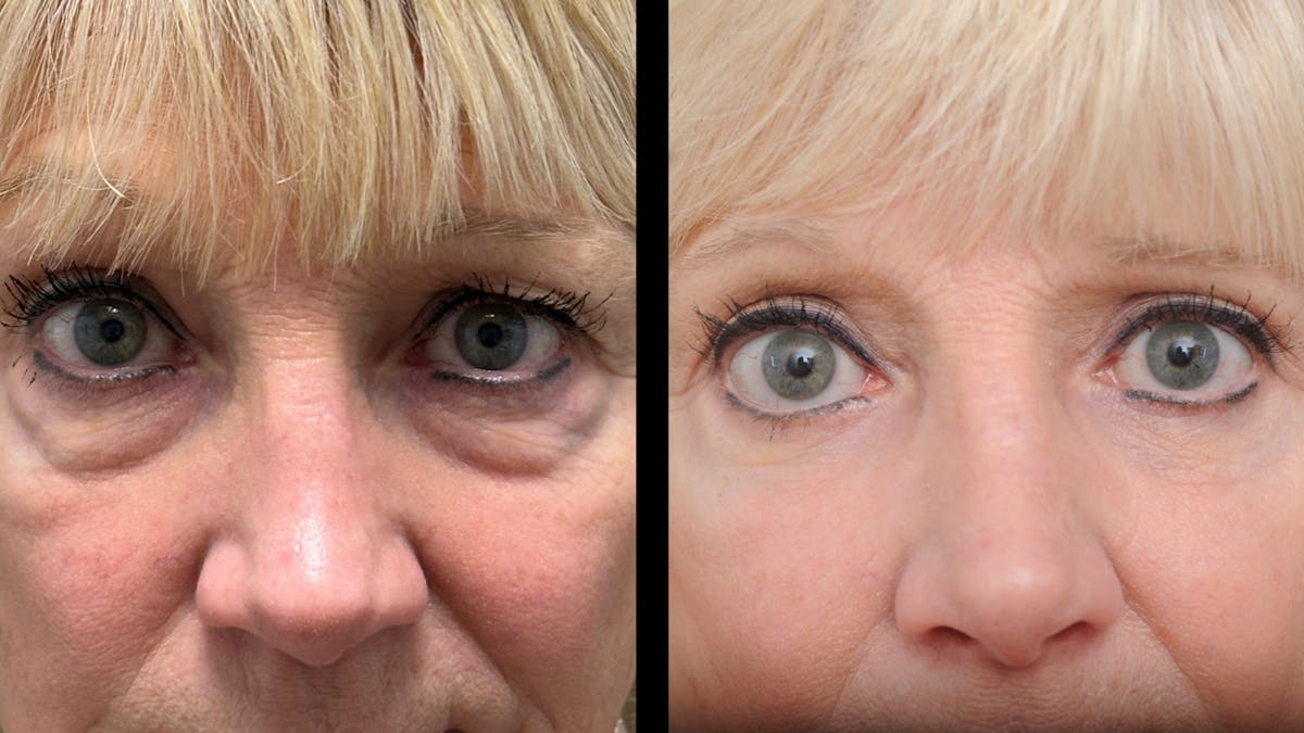 Lower Eyelid Surgery Before & After Gallery - Patient 358996 - Image 7