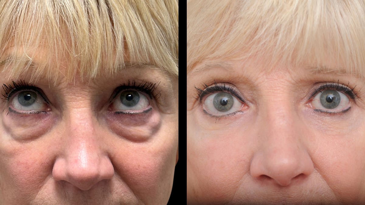 Lower Eyelid Surgery Before & After Gallery - Patient 358996 - Image 8