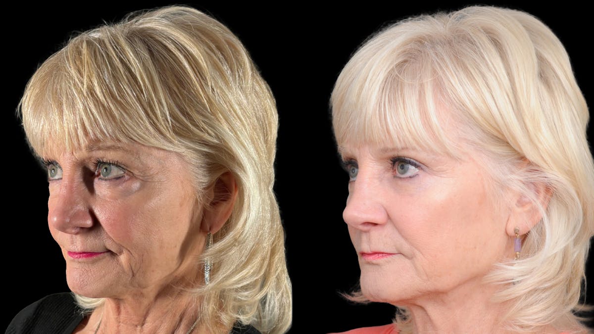 Lower Eyelid Surgery Before & After Gallery - Patient 358996 - Image 1