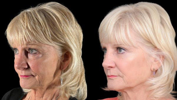 Lower Eyelid Surgery Before & After Gallery - Patient 358996 - Image 1
