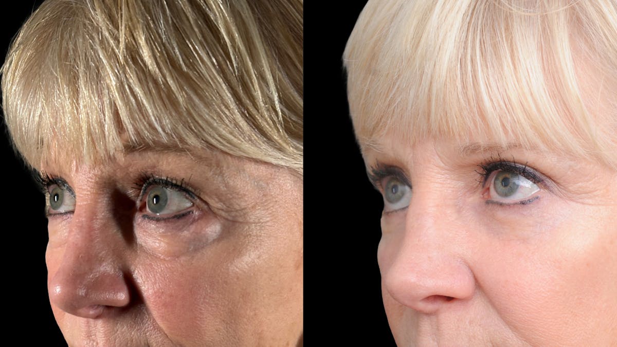 Lower Eyelid Surgery Before & After Gallery - Patient 358996 - Image 9